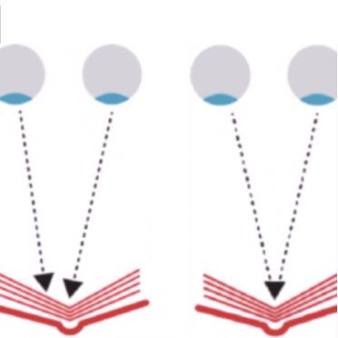 Binocular Vison Anomaly Illustration